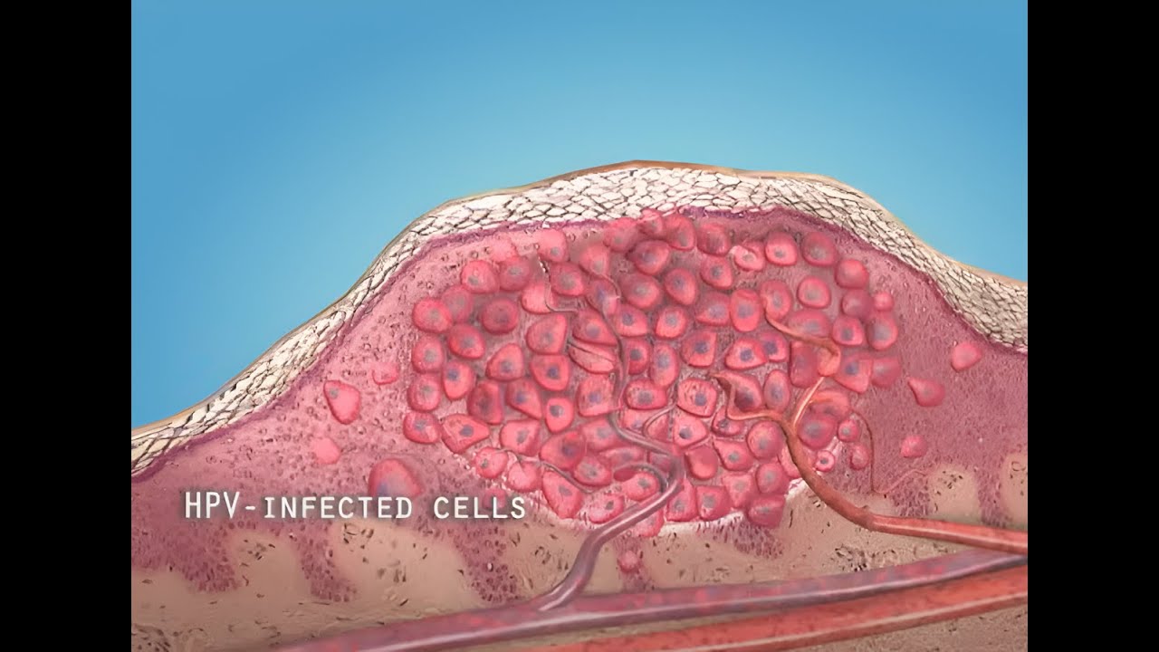 What are warts (HPV)? – 3D animation
