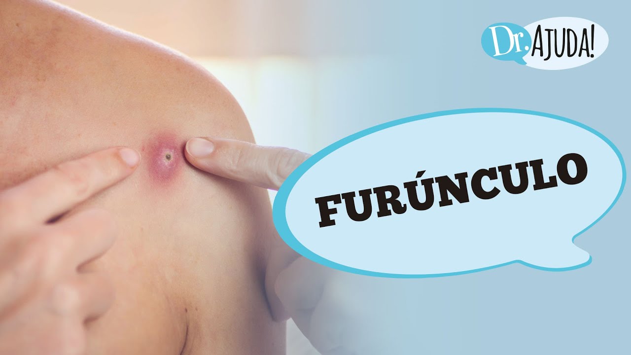 FURÚNCULO: O QUE É, COMO IDENTIFICAR, DIAGNÓSTICO, TRATAMENTO E PREVENÇÃO