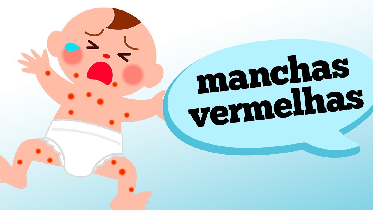 O QUE CAUSA MANCHAS VERMELHAS NO CORPO DE CRIANÇAS?