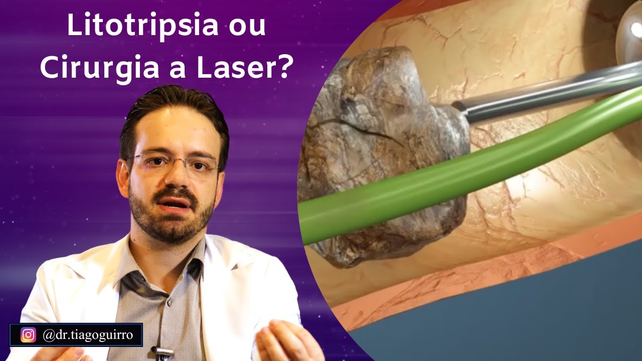 Cirurgia de Cálculo Renal – Como É?
