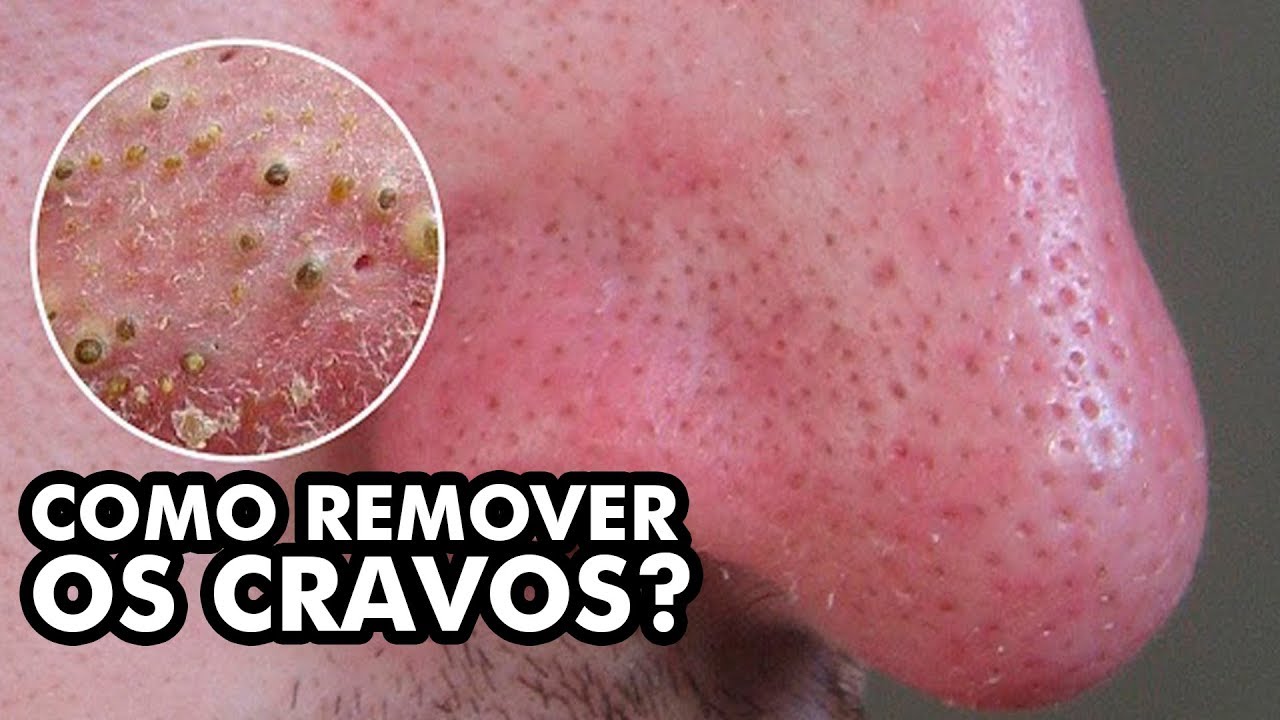 Faça ISSO para remover cravos do seu nariz